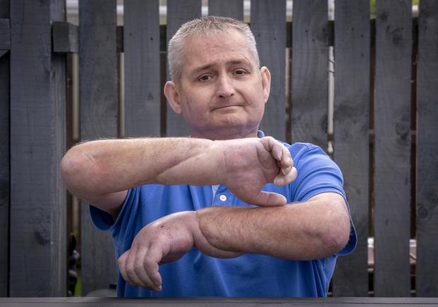 Διπλή μεταμόσχευση χεριών για έναν 42χρονο με σκληρόδερμα