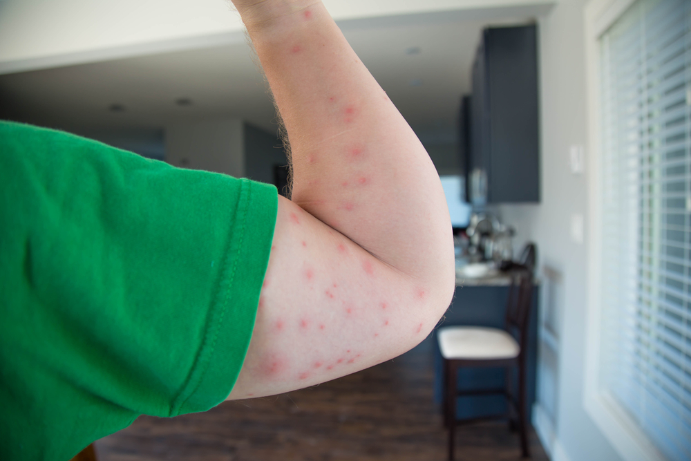 ΕΟΔΥ: 13 κρούσματα από τον ιό του Δυτικού Νείλου - Προφυλαχθείτε από τα κουνούπια