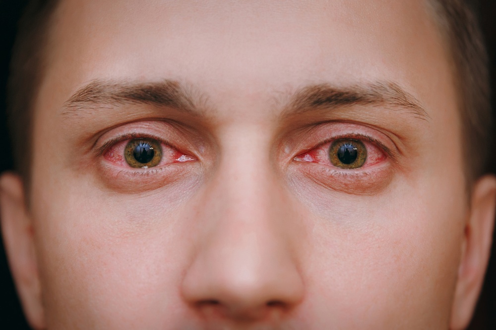 Healthstories Η ευλογιά των πιθήκων μπορεί να επηρεάσει τα μάτια και την όραση