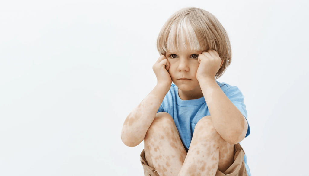 Λεύκη στα παιδιά: Τι πρέπει να γνωρίζετε για καλύτερη αντιμετώπιση