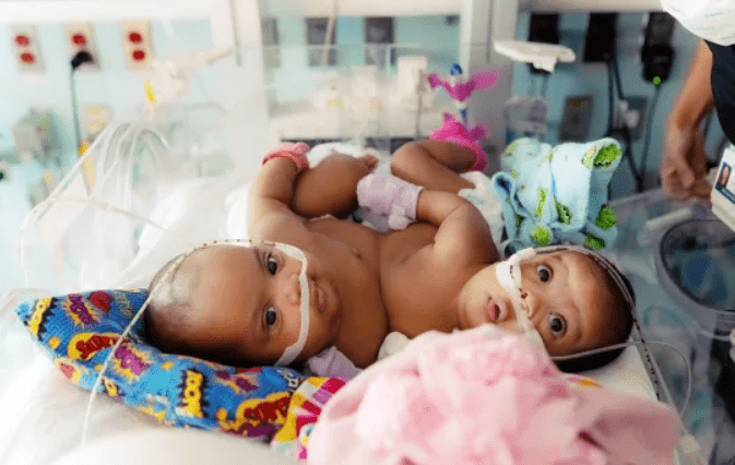 Healthstories Σιαμαία κορίτσια διαχωρίστηκαν επιτυχώς μετά από χειρουργική επέμβαση 11 ωρών