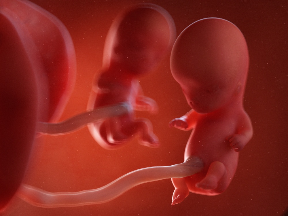 Healthstories Αγέννητο δίδυμο αφαιρέθηκε από τον εγκέφαλο μωρού