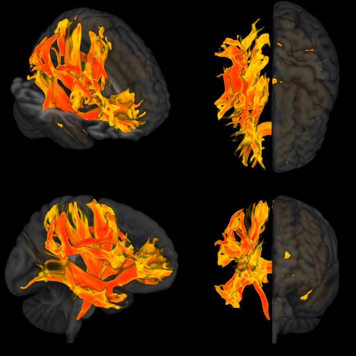 Healthstories Εντόπιστηκαν περιοχές του εγκεφάλου που επηρεάζονται από την υψηλή πίεση και σχετίζονται με την άνοια