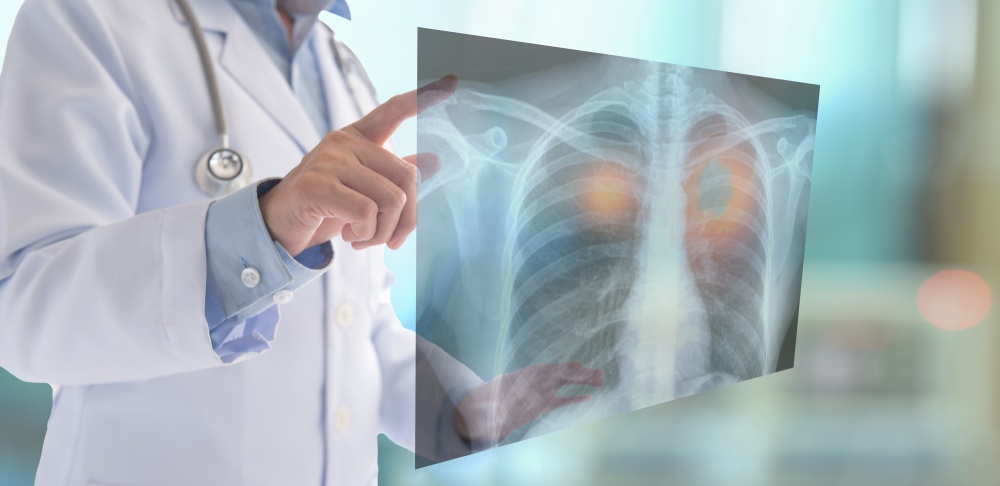 Healthstories Φυματίωση 2η αιτία θανάτου από λοιμώδες αίτιο μετά την COVID-19