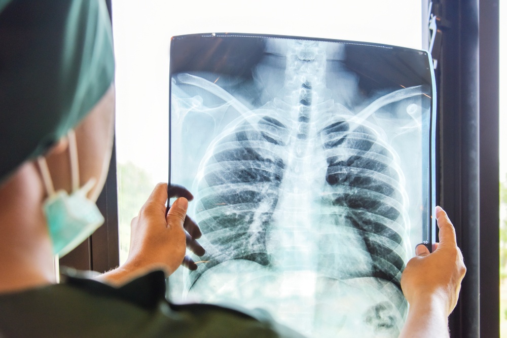Healthstories-x-ray-lung