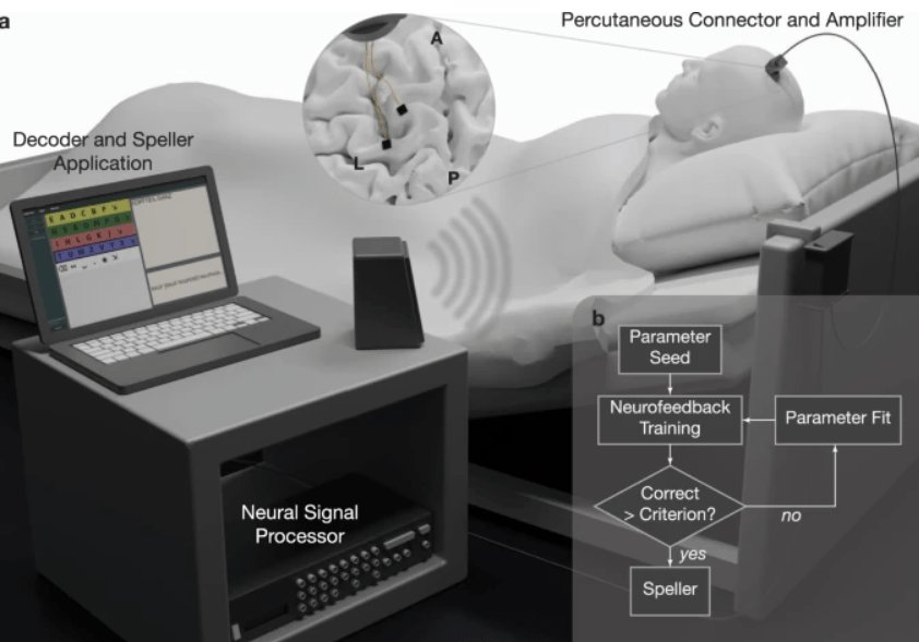 εμφύτευση συσκευής σε ασθενή με νόσο του κινητικού νευρώνα