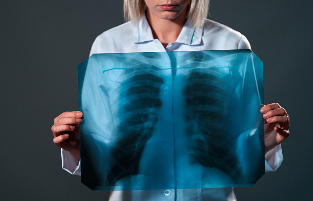 Οι εμπειρίες των ασθενών με καρκίνο του πνεύμονα στην Ελλάδα