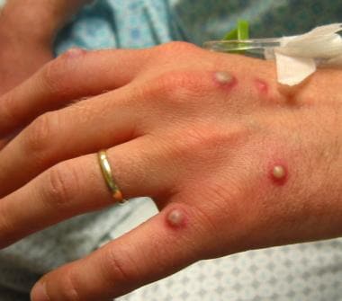 «Ευλογιά των πιθήκων» : Πόσο επικίνδυνος είναι ο ιός, που εμφανίστηκε στην Βρετανία