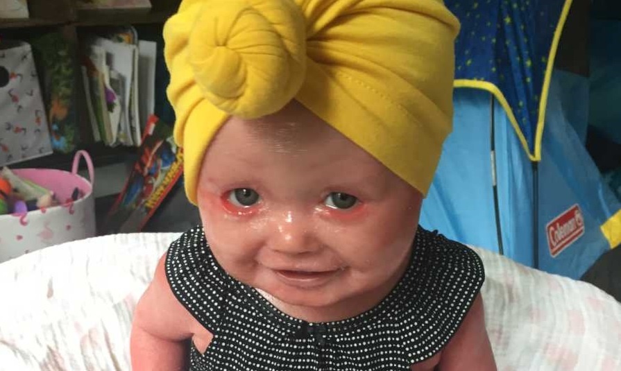 «Το δέρμα της στέγνωνε σε δευτερόλεπτα και γέμιζε ρωγμές»: Συγκλονίζει μωράκι με ιχθύαση αρλεκίνου