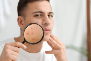 Δέρμα με ακμή; Το ιδανικό αντιηλιακό προσώπου που προστατεύει το μικροβίωμα του δέρματος