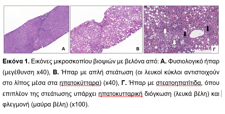 Healthstories Μη αλκοολικη λιπώδης νόσος του ήπατος Μία σύγχρονη επιδημία