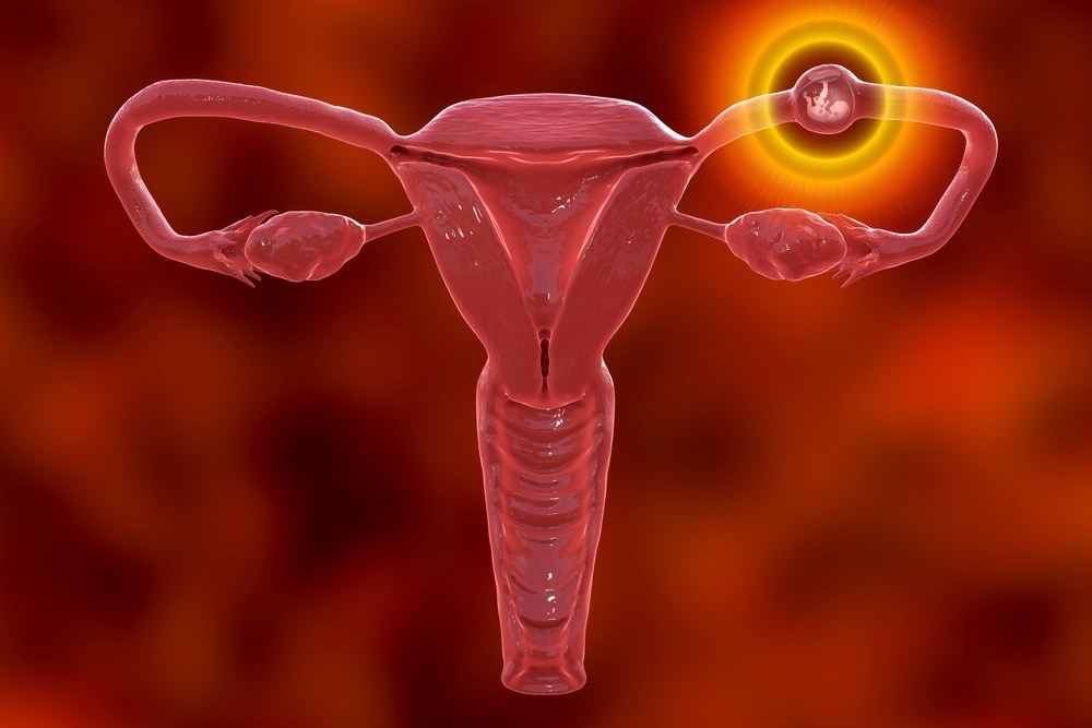 Healthstories Τι είναι η έκτοπη εγκυμοσύνη