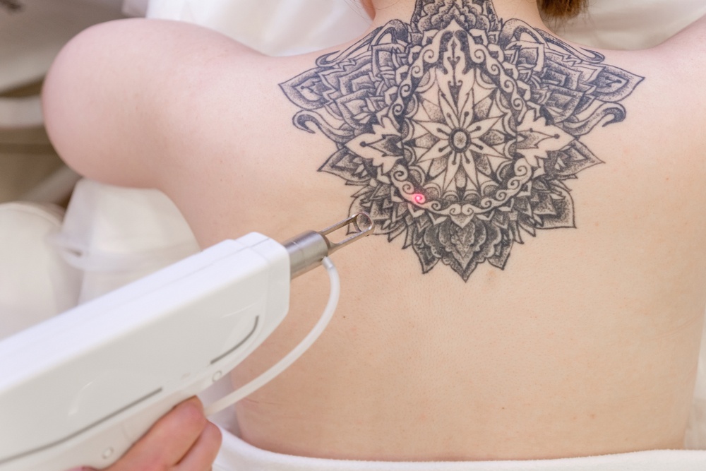Healthstories Αφαίρεση τατουάζ Η κατάλληλη εποχή για να διώξετε ακόμα και τα ανοικτόχρωμα σχέδια