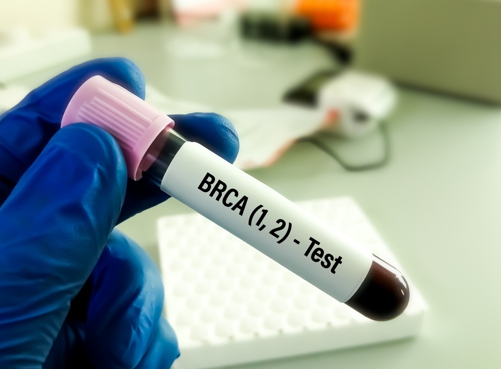 Η προφυλακτική σαλπιγγο-ωοθηκεκτομή αυξάνει την επιβίωση σε ασθενείς με καρκίνο μαστού και BRCA μεταλλάξεις
