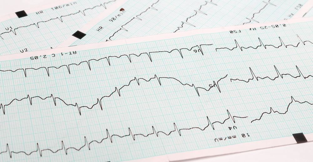 Αρρυθμίες σε άτομα με φυσιολογική καρδιά - Πρέπει να μας ανησυχούν