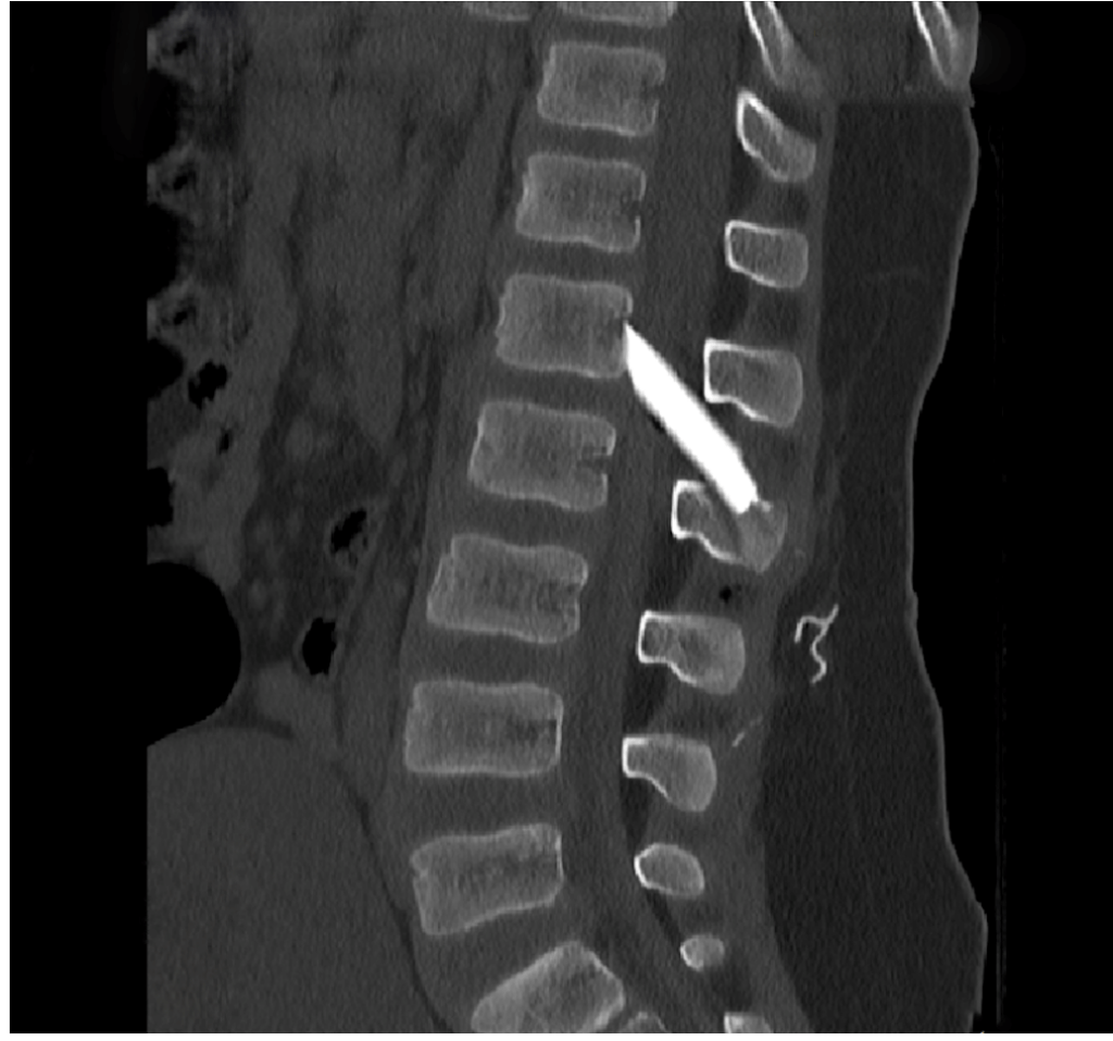 spondyliki-stili-paidioy